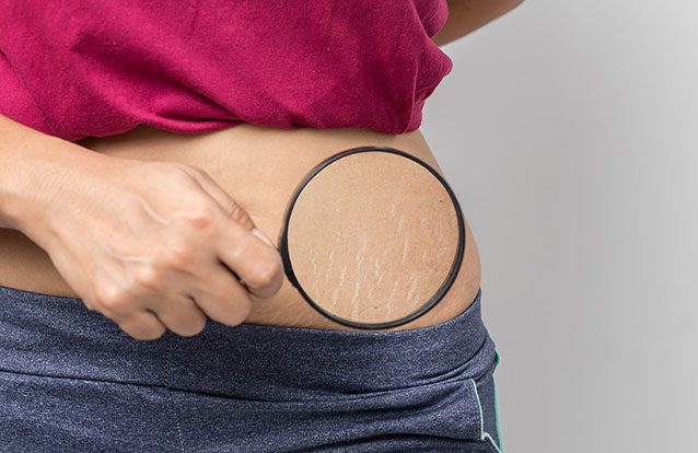 Woman with stretch mark treatment in Bay Area