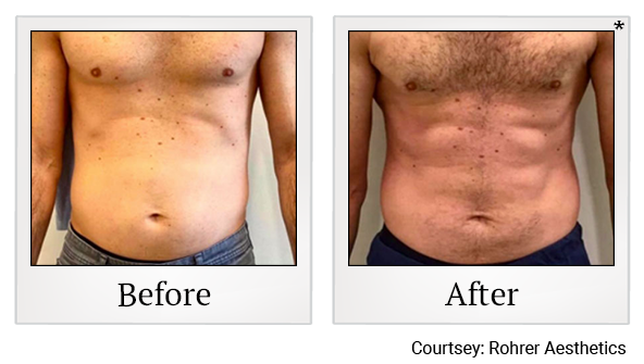 Results 2 of bodytone treatment at Bay Area Med Spas in Oakland and Fremont