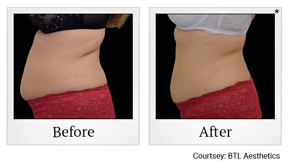 Results of Emsculpt NEO treatment at Bay Area Med Spas in Oakland and Fremont