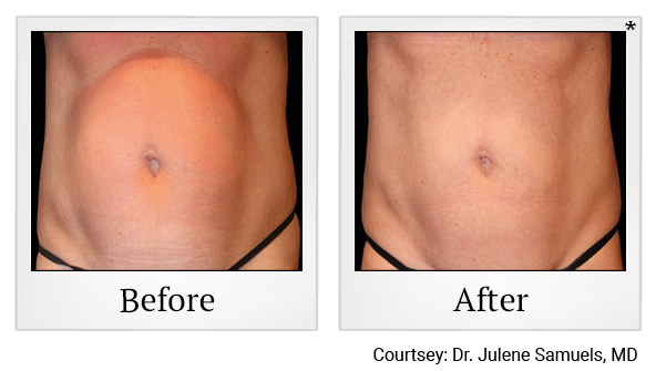 Results of Emsculpt NEO treatment at Bay Area Med Spas in Oakland and Fremont