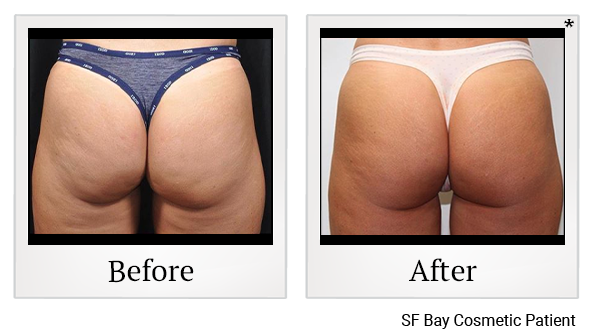 Results of Emsculpt treatment at Bay Area Med Spas in Oakland and Fremont