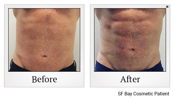 Results 90 of emsculpt treatment at Bay Area Med Spas in Oakland and Fremont