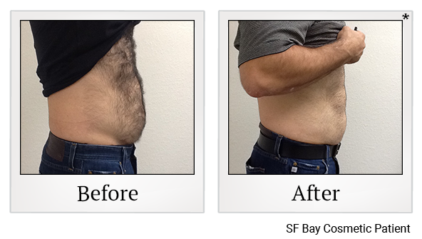 Results of Emsculpt treatment at Bay Area Med Spas in Oakland and Fremont