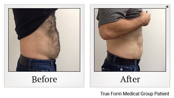 Results of Emsculpt treatment at Bay Area Med Spas in Oakland and Fremont