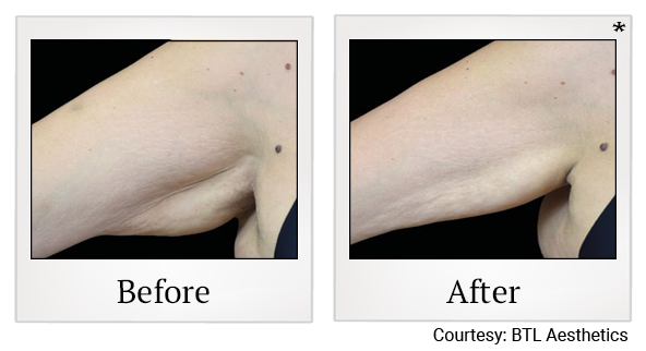 Results of Emtone treatment at Bay Area Med Spas in Oakland and Fremont