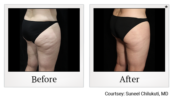 Results 15 of exilis ultra treatment at Bay Area Med Spas in Oakland and Fremont