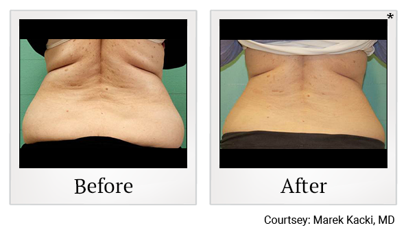 Results 31 of exilis ultra treatment at Bay Area Med Spas in Oakland and Fremont
