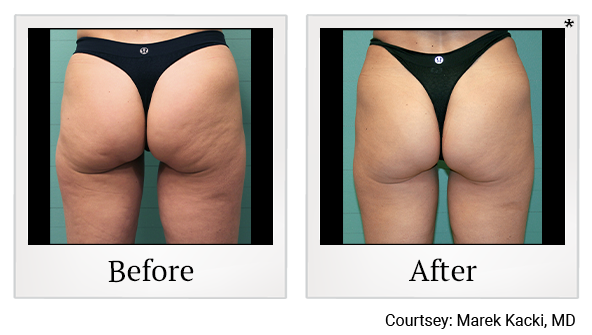 Results 33 of exilis ultra treatment at Bay Area Med Spas in Oakland and Fremont