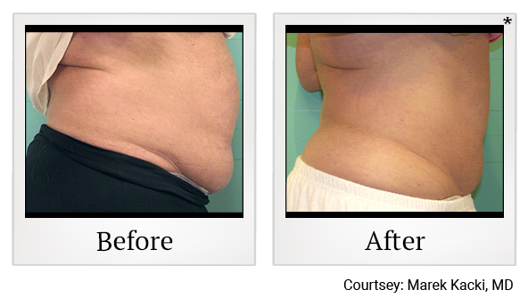 Results 34 of exilis ultra treatment at Bay Area Med Spas in Oakland and Fremont