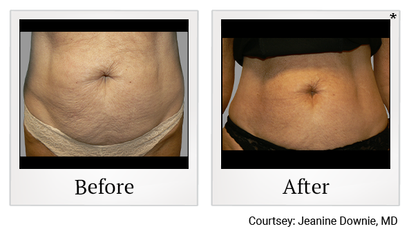 Results of Exilis Ultra treatment at Bay Area Med Spas in Oakland and Fremont