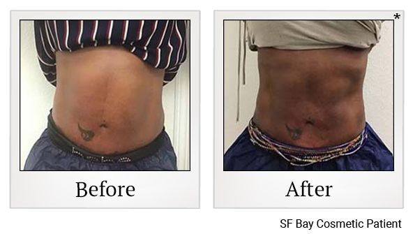 Results 3 of exilis ultra treatment at Bay Area Med Spas in Oakland and Fremont