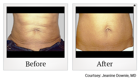 Results 8 of exilis ultra treatment at Bay Area Med Spas in Oakland and Fremont