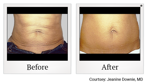 Results of Exilis Ultra treatment at Bay Area Med Spas in Oakland and Fremont