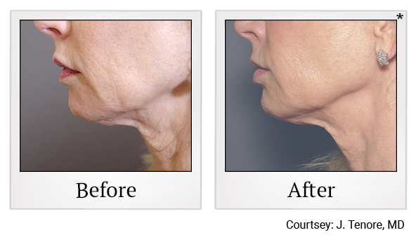 Results 9 of exilis ultra treatment at Bay Area Med Spas in Oakland and Fremont