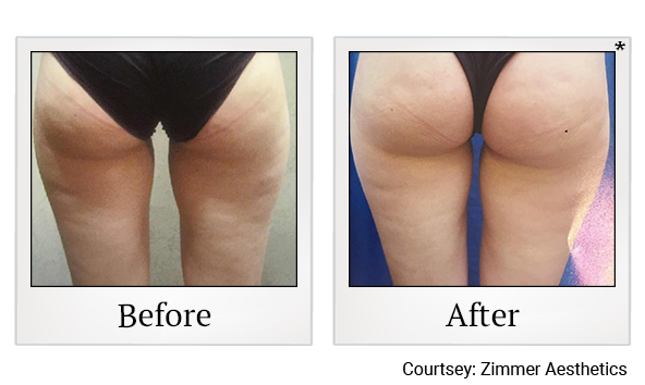 Results of Z Wave Pro treatment at True Form Medical Group in Oakland and Fremont