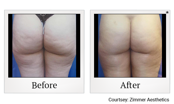 Results of Z Wave Pro treatment at True Form Medical Group in Oakland and Fremont