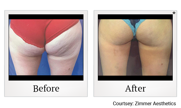 Results of Z Wave Pro treatment at True Form Medical Group in Oakland and Fremont