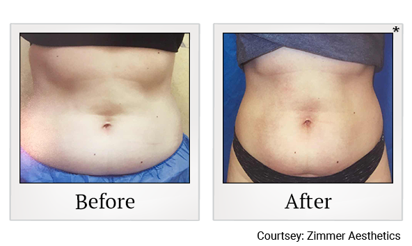 Results of Z Wave Pro treatment at True Form Medical Group in Oakland and Fremont