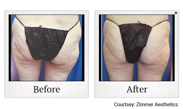 Results of Z Wave Pro treatment at True Form Medical Group in Oakland and Fremont