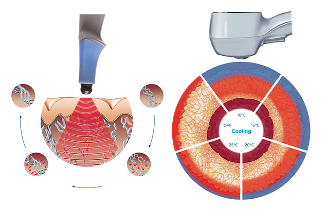 How Exilis Ultra works at Bay Area Med Spas in Oakland and Fremont